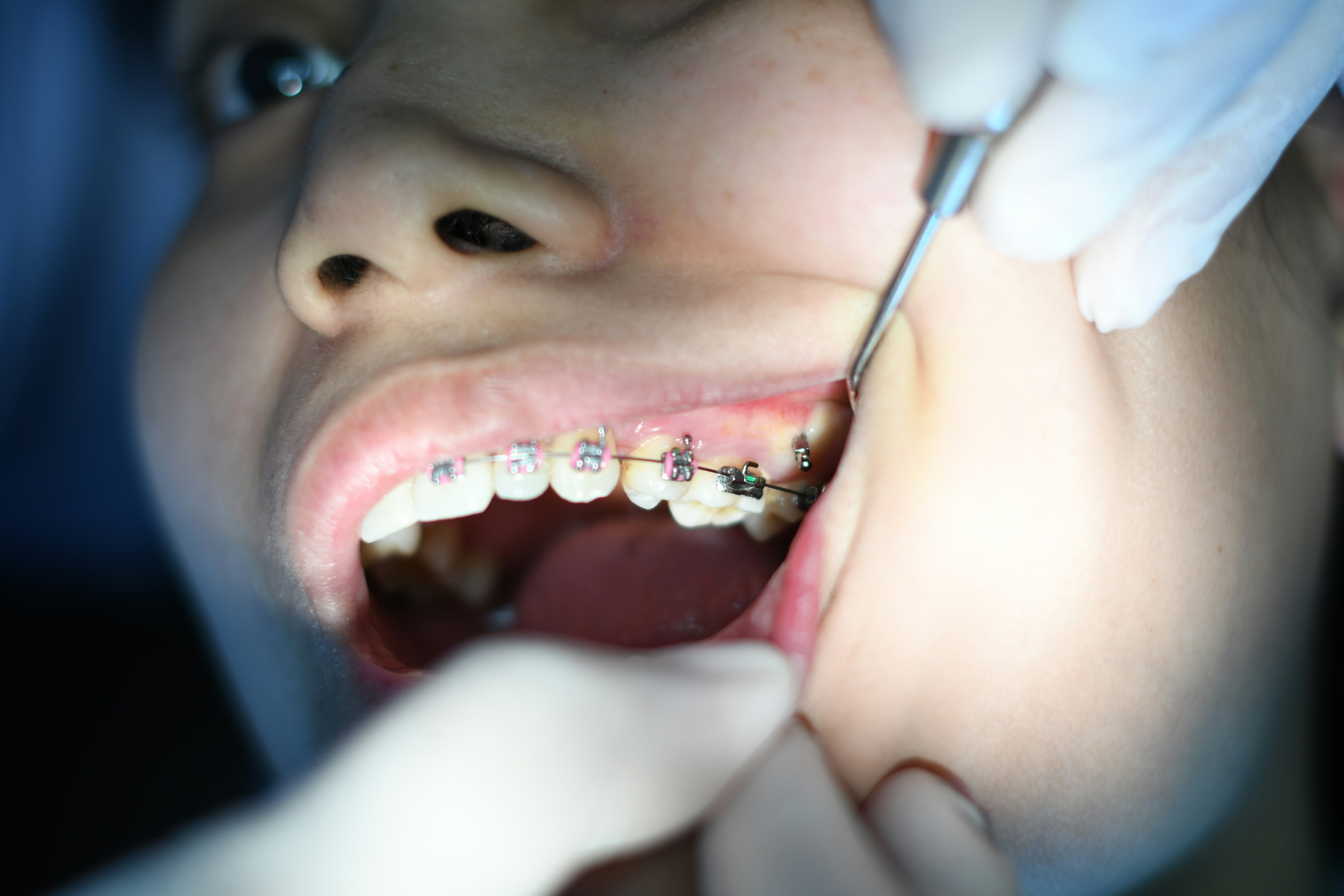Dental Fillings