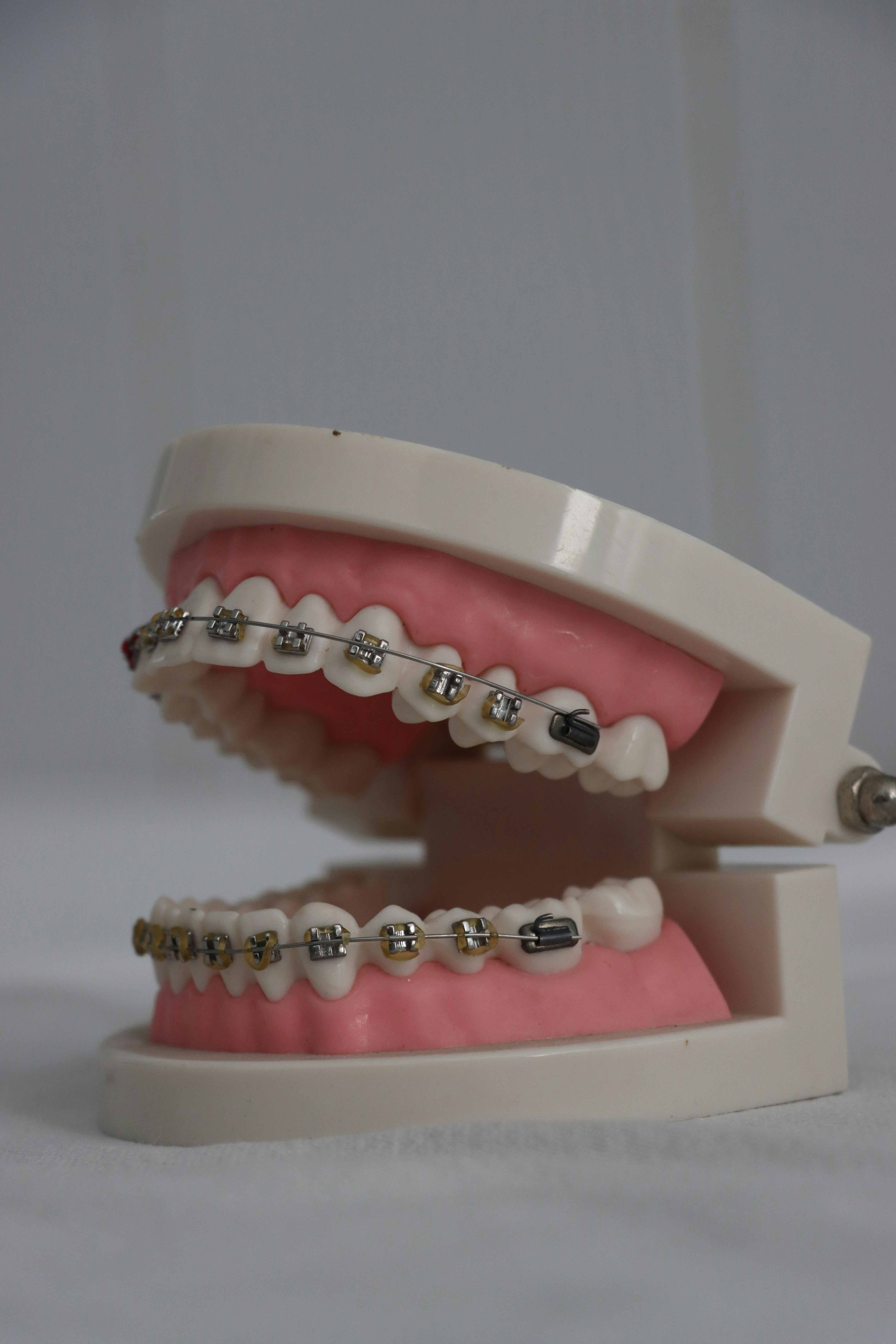 Dental Crowns & Bridges